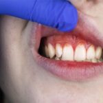 The Role Of A Periodontist In Treating Oral Infections