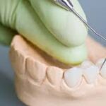Exploring The Advantages Of Dental Bridges In Cosmetic Dentistry