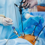 Obstetricians And Gynecologists: Leading The Way In Laparoscopic Surgery