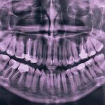 Decoding Dental X-Rays: Insights From A General Dentist