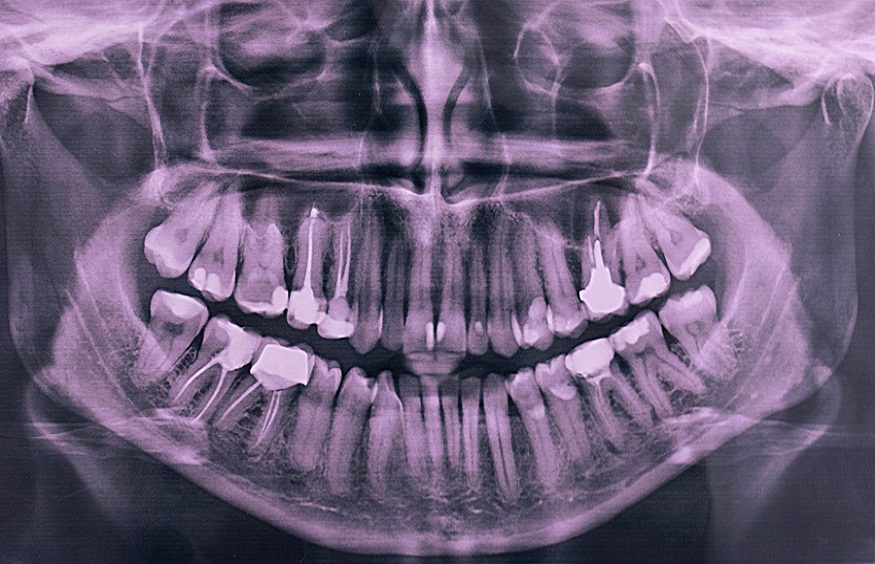 Dental X-Rays