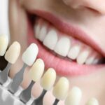 Want that perfect smile? Consider getting dental veneers!