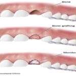 Bone Regeneration in Periodontics: Advances in Treating Severe Gum Disease