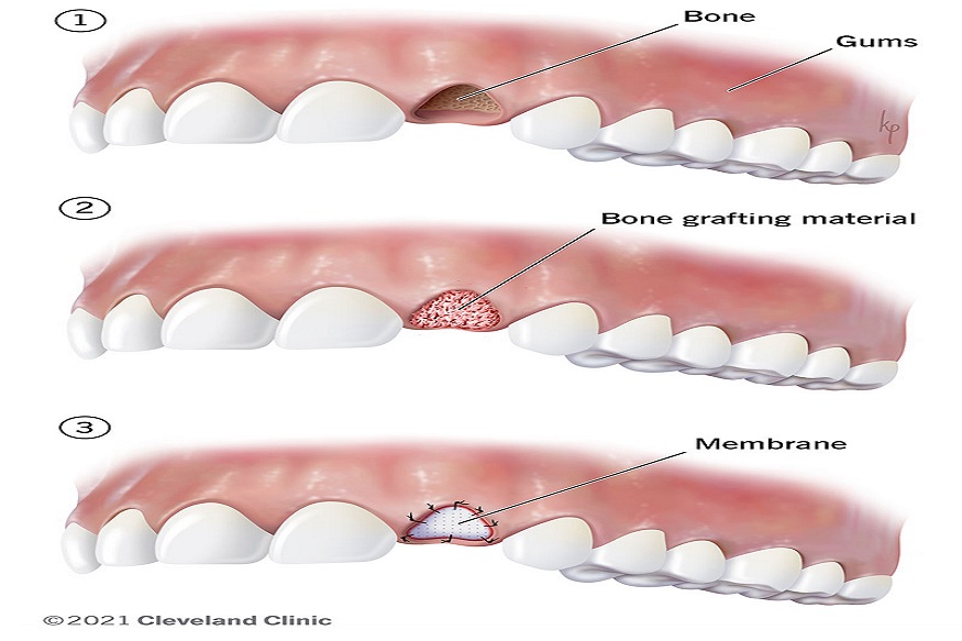 Bone Regeneration in Periodontics