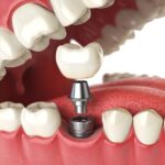 The Complete Guide to Dental Implant Types: Which One is Right for You?