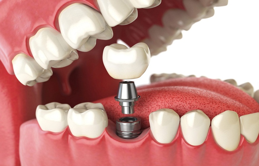 Dental Implant Types