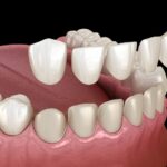 Are Dental Veneers the Key to a Celebrity Smile? Here’s What You Should Know?