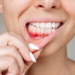 Stages of Gum Disease in Fort Lee, NJ