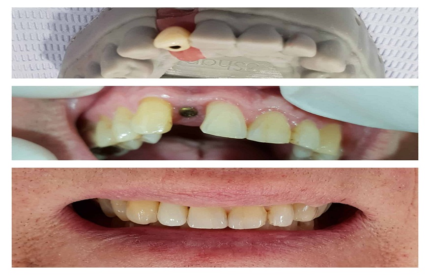 Replacing missing teeth