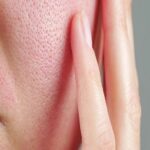 Common Mistakes to Avoid When Treating Acne: What You Should Know