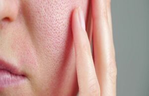 Common Mistakes to Avoid When Treating Acne: What You Should Know